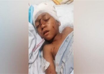 अंबाला में एक साथ 10 कुत्तों ने मासूम को नोंचा, सिर के आधे हिस्से की खाई खाल