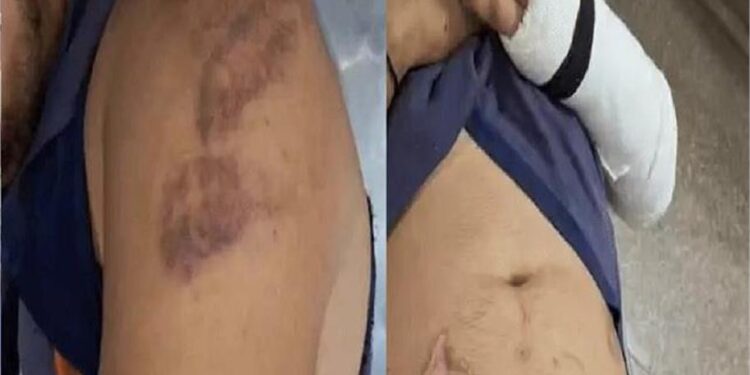 ये कैसा सिस्टम!  पुलिसकर्मियों ने युवक के Private Part में डाला डंडा, ज्यादा ब्लीडिंग से हुआ बेहोश… फिर